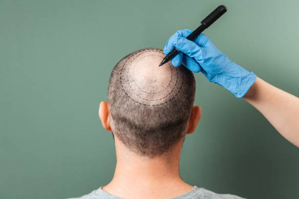 Trichologist outlines the area of baldness on the client's head with a marker. Rear view. Green background. The concept of alopecia and mesotherapy.